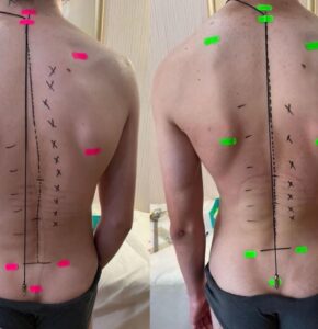Оздоровительный и лечебный массаж спины в медицинском центре Ocsarat Medical Одесса